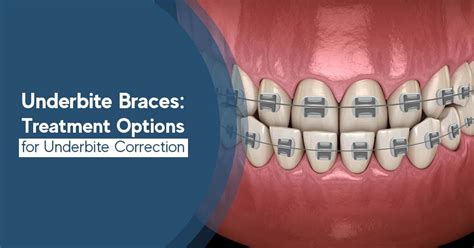 underbite metal bracket|surgery for underbite correction.